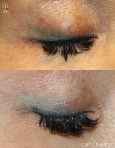 Excellent results with tattoo removal lasers using the picosecond lasers to treat the brow tattoos and lid liner tattoos by Dr BCK Patel MD of Salt Lake City and St George, Utah