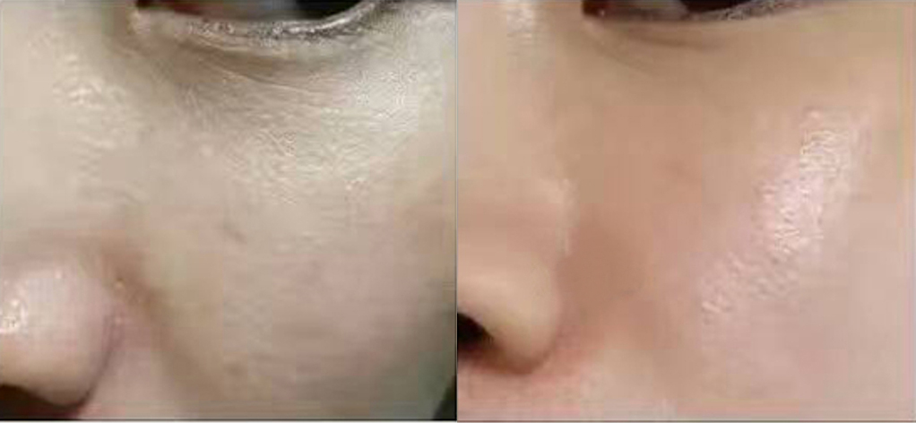 Dark circles around the eyes treated with picosecond lasers and peels by Treatment of pores by Dr. BCK Patel MD, FRCCS Dark circles around eyes treated by Dr BCK Patel MD of Salt Lake City and St George, Utah