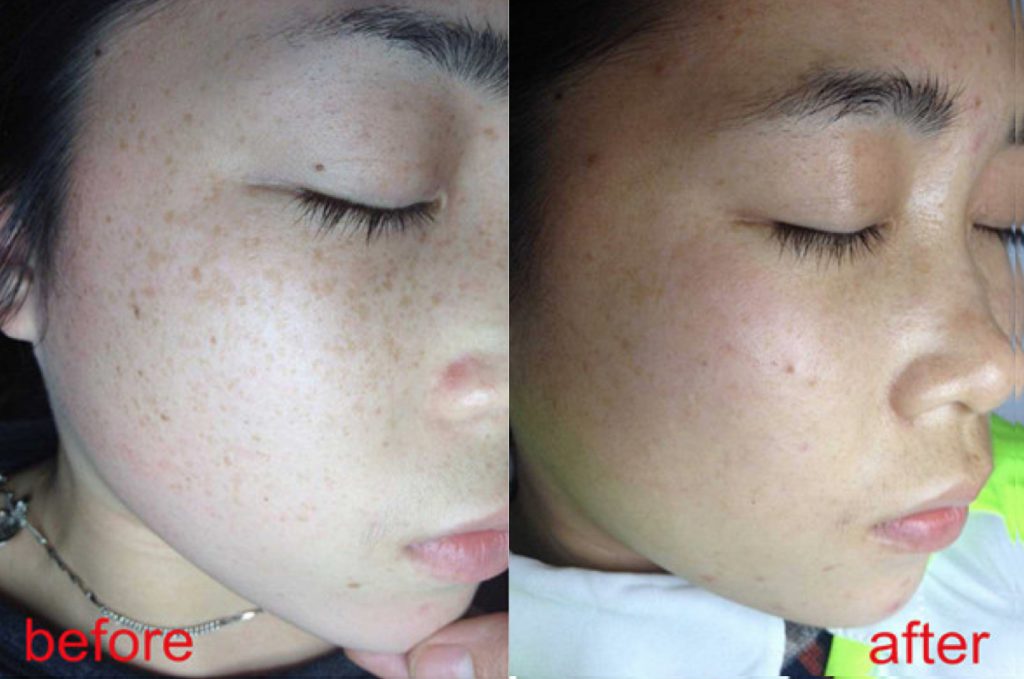 Sun damaged skin of the face treated with beautiful results using advanced lasers by Dr. BCK Patel of Salt Lake City and St George Utah