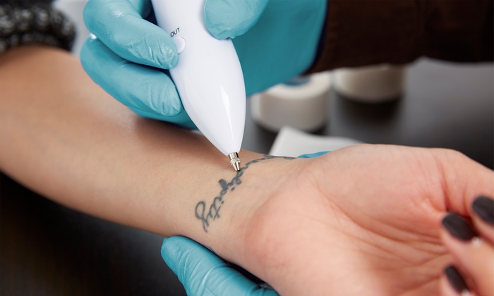 Tattoo removal using picosecond lasers by Dr. BCK Patel MD, FRCS of Salt Lake City and St George, Utah