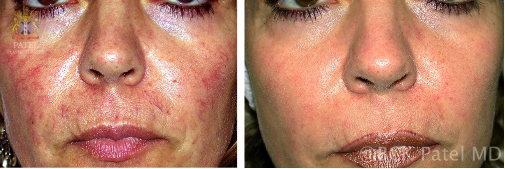 Acne rosacea treatment with lasers. Treatment of aging skin with wrinkles and sun damage on the neck and chest with advanced lasers by Dr BCK Patel of Salt Lake City and St George Utah