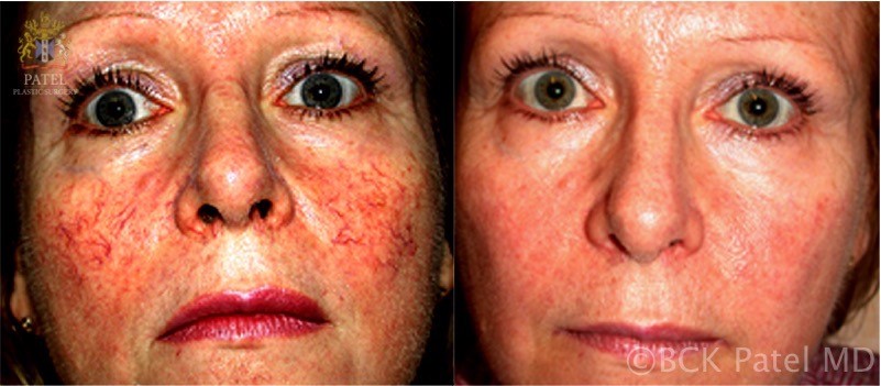 Acne rosacea treatment results. with