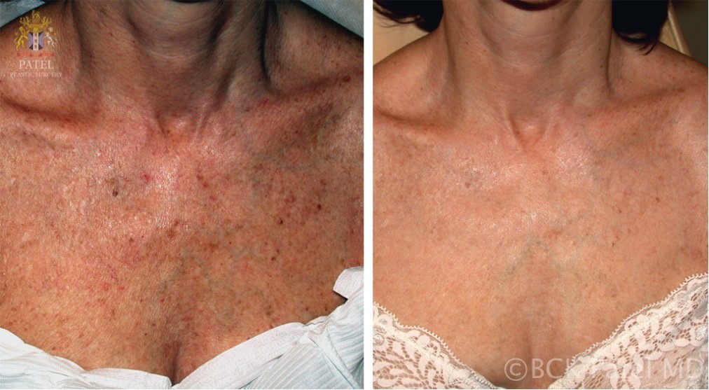 Treatment of aging skin with wrinkles and sun damage on the neck and chest with advanced lasers by Dr BCK Patel of Salt Lake City and St George Utah