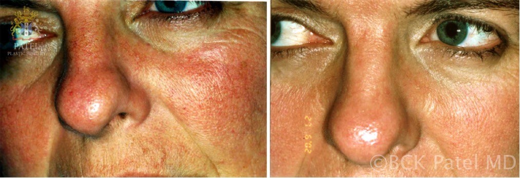 Acne rosacea treatment