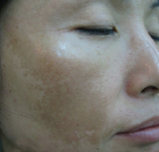 Melasma treatment with picosecond laser