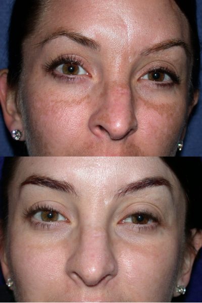Melasma before and after results. Photos and treatments by of Salt Lake City and St George, Utah Dr BCK Patel MD