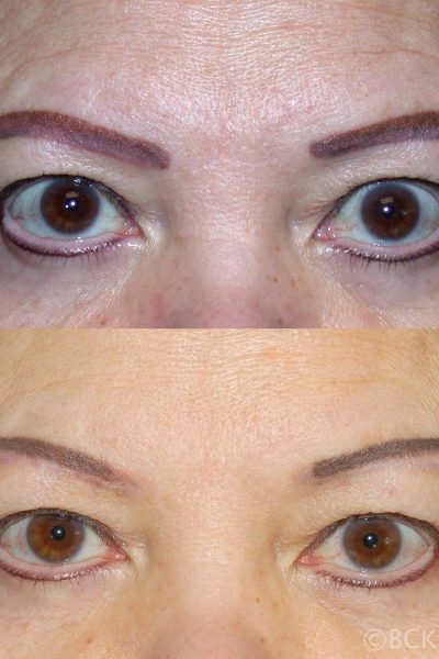 Tattoo removal of the brows and eyelid liner