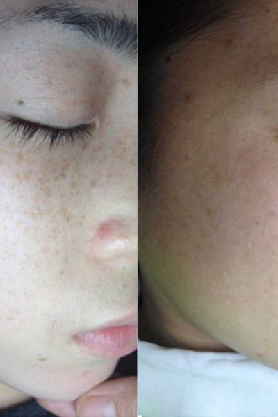 Sun damaged skin of the face treated with beautiful results using advanced lasers by Dr. BCK Patel of Salt Lake City and St George Utah