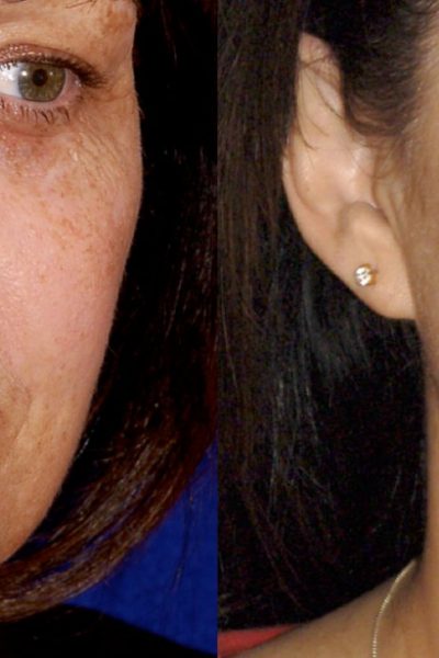 Sun damaged skin of the face treated with beautiful results using advanced lasers by Dr. BCK Patel of Salt Lake City and St George Utah