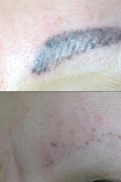 Excellent results with tattoo removal lasers using the picosecond lasers to treat the brow tattoos and lid liner tattoos by Dr BCK Patel MD of Salt Lake City and St George, Utah