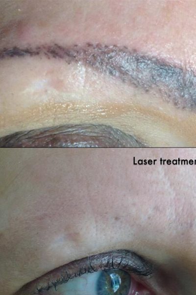 Tattoo removal of the brow tattoos: Sun damaged skin of the face treated with beautiful results using advanced lasers by Dr. BCK Patel of Salt Lake City and St George Utah
