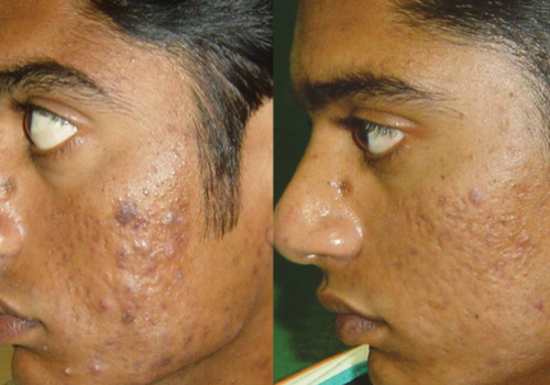acne-erbium.png Acne treatments by Dr BCK patel MD Excellent results with tattoo removal lasers using the picosecond lasers to treat the brow tattoos and lid liner tattoos by Dr BCK Patel MD of Salt Lake City and St George, Utah
