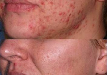 Acne treatment Excellent results with tattoo removal lasers using the picosecond lasers to treat the brow tattoos and lid liner tattoos by Dr BCK Patel MD of Salt Lake City and St George, Utah