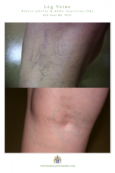 Leg veins treated with lasers and injections by Dr BCK Patel MD of Salt Lake City and St George Utah