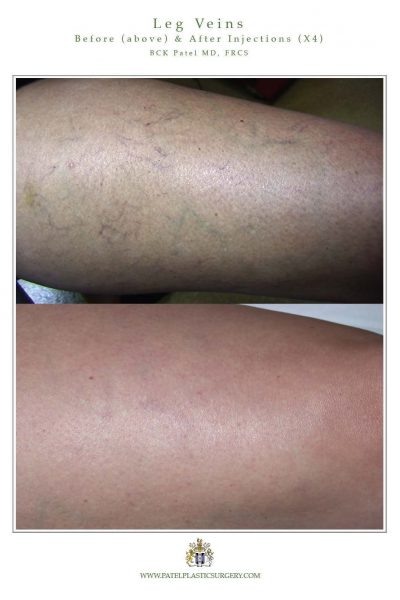 Leg veins treated with lasers and injections by Dr BCK Patel MD of Salt Lake City and St George Utah