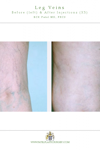 Leg veins treated with lasers and injections by Dr BCK Patel MD of Salt Lake City and St George Utah