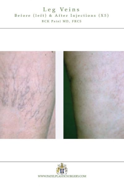 Leg veins treated with injections and lasers. Treatment by Dr BCK Patel MD, FRCS of Salt Lake City and St George, Utah