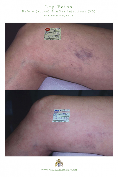Leg vein treatments with lasers and injections by Dr BCK Patel MD of Salt Lake City and St George Utah