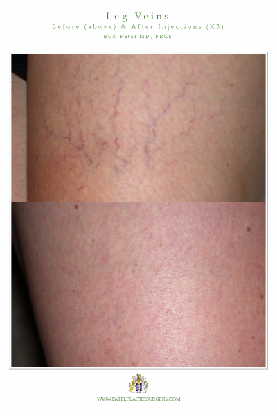 Leg vein treatments by Dr BCK Patel MD of Salt Lake City and St George Utah