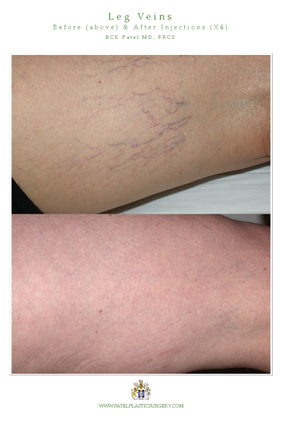 Leg vein injection and laser treatment by Dr BCK Patel MD of Salt Lake City and St George Utah
