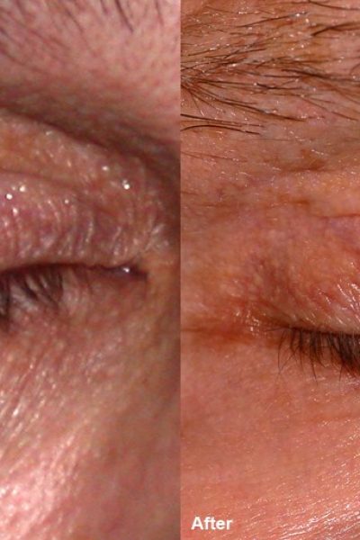 Eyelid wrinkles treated with the CO2 laser by Dr BCK Patel of Salt Lake City and St George Utah