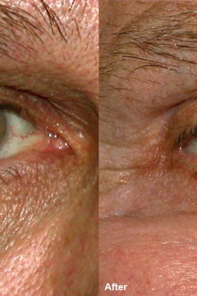 Eyelid and smile wrinkles treated with the co2 laser by Dr BCK Patel MD