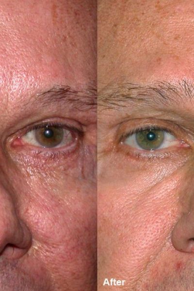 Skin rejuvenation by Dr BCK Patel