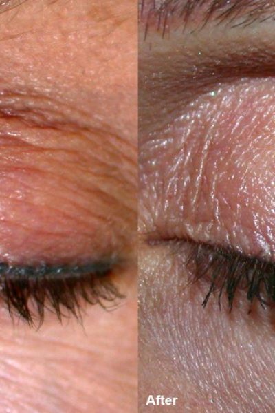 Eyelid wrinkles