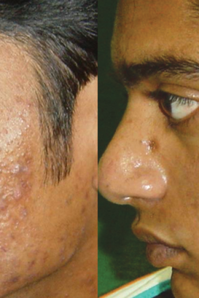 Acne treatment by Dr BCK Patel